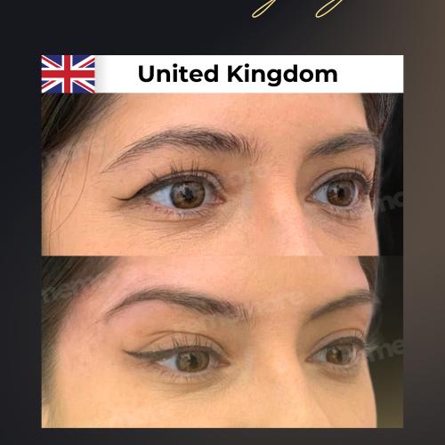 رأب الجفن صور ماقبل / ما بعد